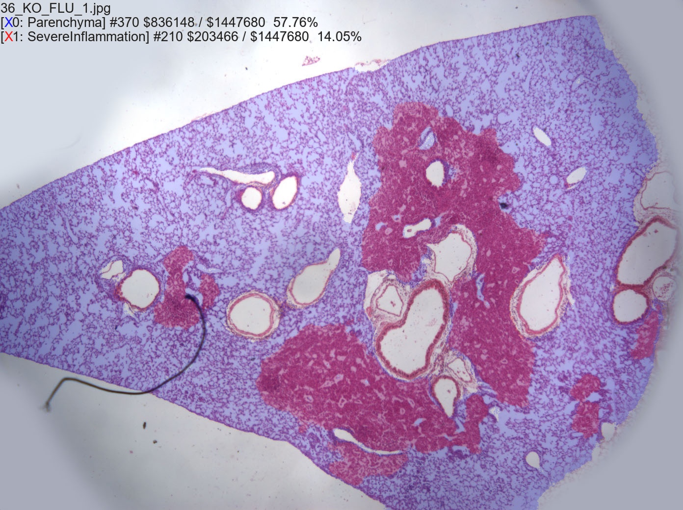 both parenchyma and severe inflammation in the lung alt text